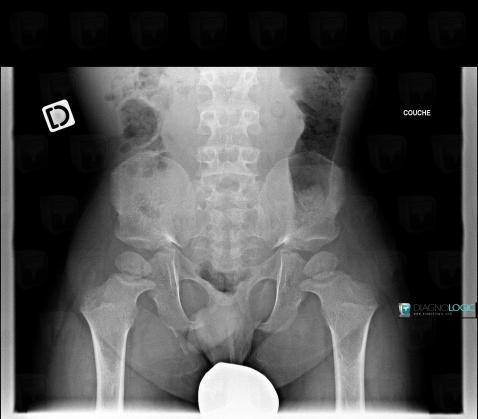 Achondroplasia, Ilium, X rays