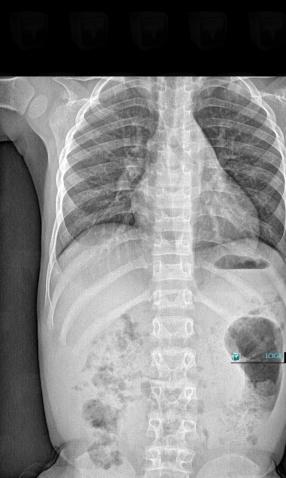 Achondroplasia, Vertebral body / Disk, X rays