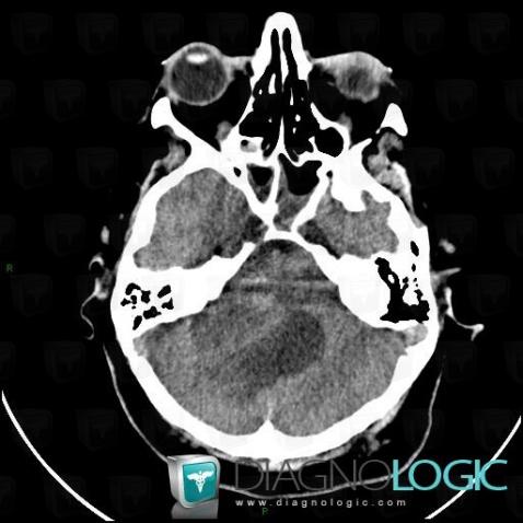 Acoustic schwannoma, Cerebellopontine angle, Infratentorial peri cerebral spaces, CT