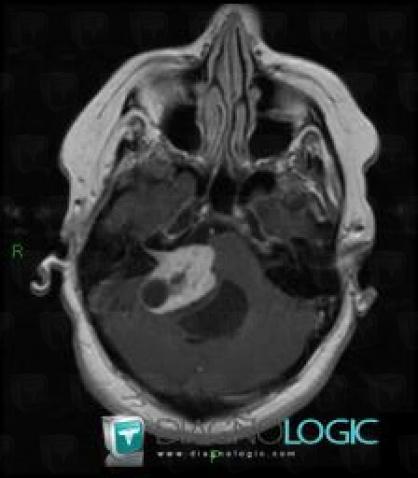 Acoustic schwannoma, Cerebellopontine angle, Infratentorial peri cerebral spaces, MRI