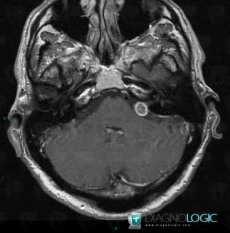 Acoustic schwannoma, Cerebellopontine angle, Infratentorial peri cerebral spaces, MRI