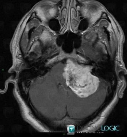 Acoustic schwannoma, Cerebellopontine angle, Infratentorial peri cerebral spaces, MRI