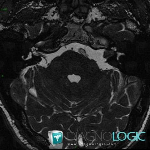 Acoustic schwannoma, Cerebellopontine angle, VII VIII nerves, MRI