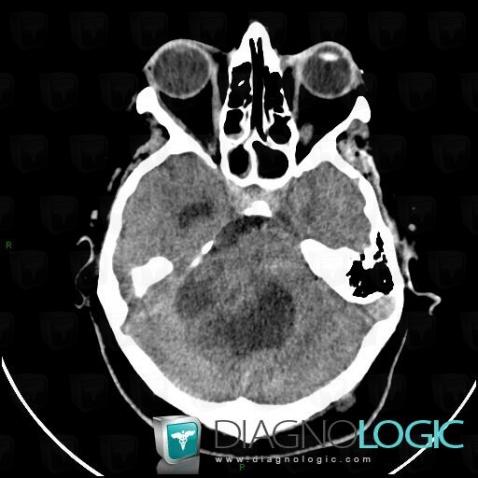 Acoustic schwannoma, Posterior fossa, CT