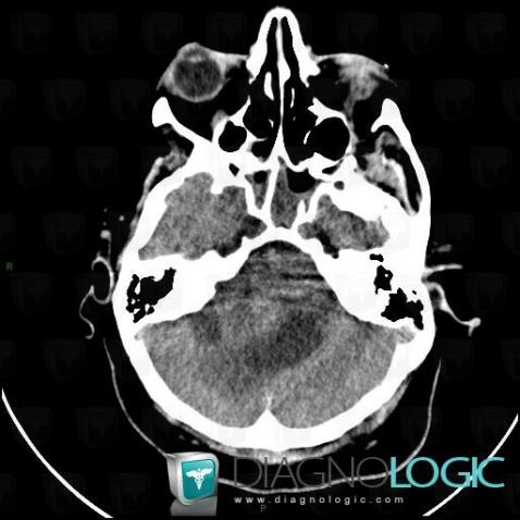 Acoustic schwannoma, Posterior fossa, CT