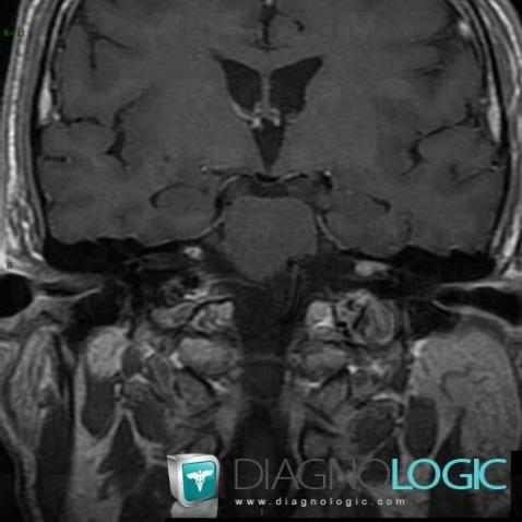 Acoustic schwannoma, Posterior fossa, MRI