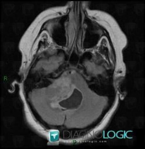 Acoustic schwannoma, Posterior fossa, MRI