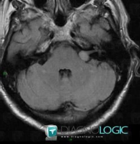 Acoustic schwannoma, Posterior fossa, MRI