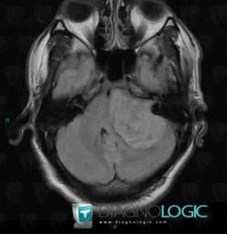 Acoustic schwannoma, Posterior fossa, MRI