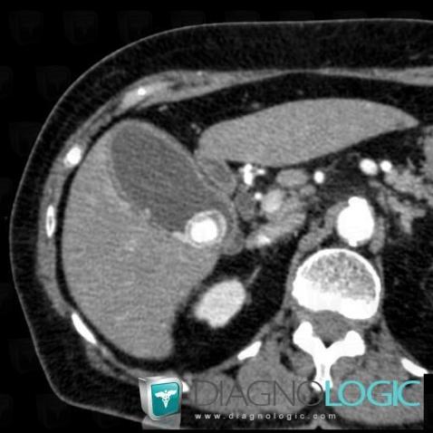 Acute cholecystitis, Gallbladder, CT