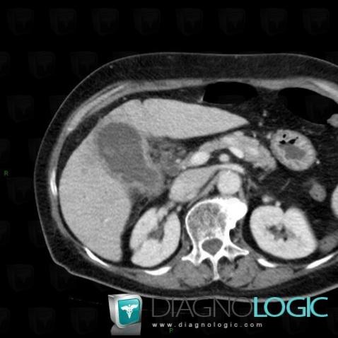 Acute cholecystitis, Gallbladder, CT