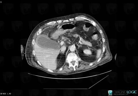 Acute cholecystitis, Gallbladder, CT