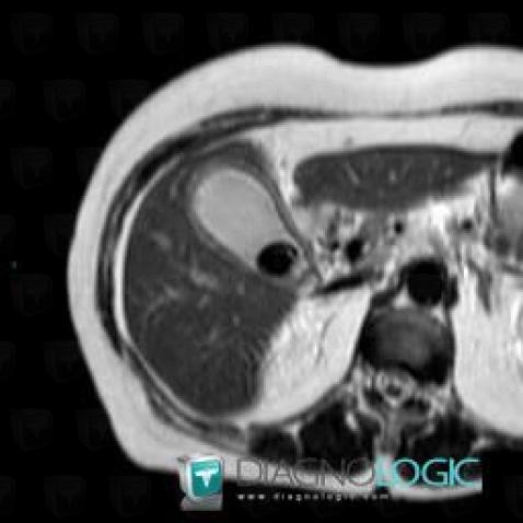 Acute cholecystitis, Gallbladder, MRI