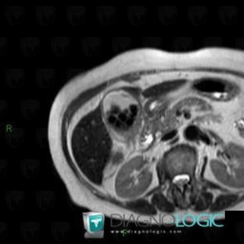 Acute cholecystitis, Gallbladder, MRI