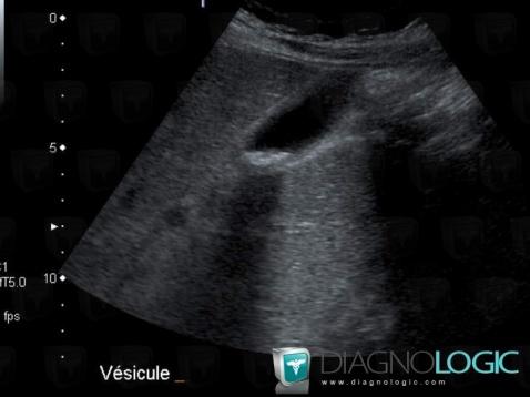 Acute cholecystitis, Gallbladder, US