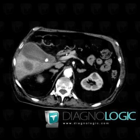 Acute cholecystitis, Liver, CT