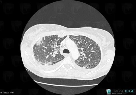 Acute eosinophilic pneumonia, Pulmonary parenchyma, CT