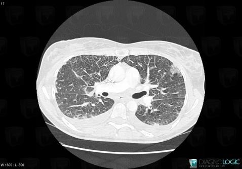 Acute eosinophilic pneumonia, Pulmonary parenchyma, CT