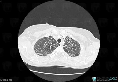 Acute eosinophilic pneumonia, Pulmonary parenchyma, CT