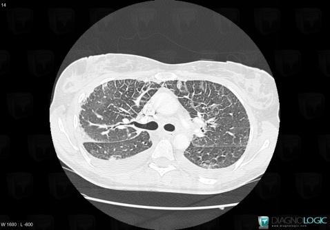 Acute eosinophilic pneumonia, Pulmonary parenchyma, CT