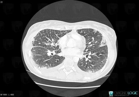 Acute eosinophilic pneumonia, Pulmonary parenchyma, CT