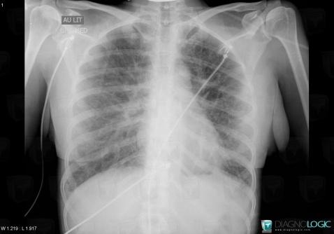 Acute eosinophilic pneumonia, Pulmonary parenchyma, X rays