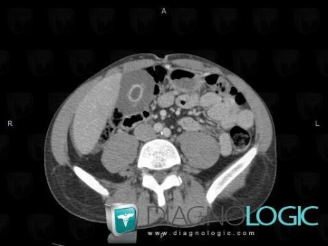 Acute hepatitis, Gallbladder, CT