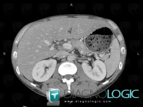 Acute hepatitis, Liver, CT