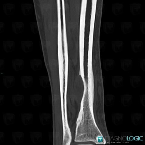 Adamantinoma, Tibia - Distal part, CT