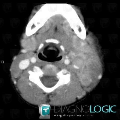 Adenitis, Deep neck spaces, CT