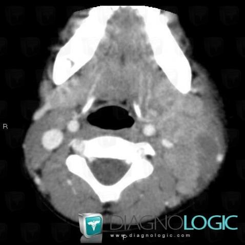 Adenitis, Deep neck spaces, CT