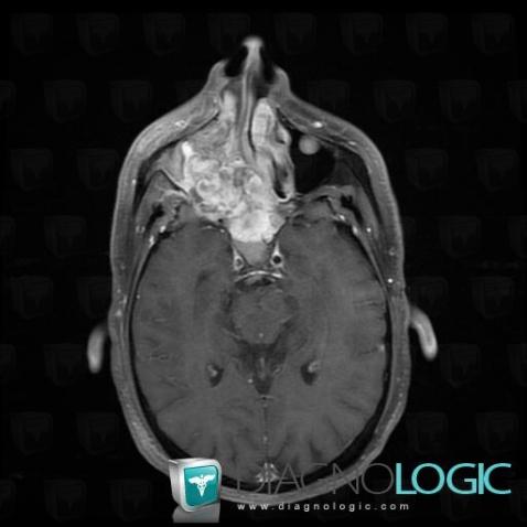 Adénocarcinome, Fosses nasales / Nasopharynx, IRM