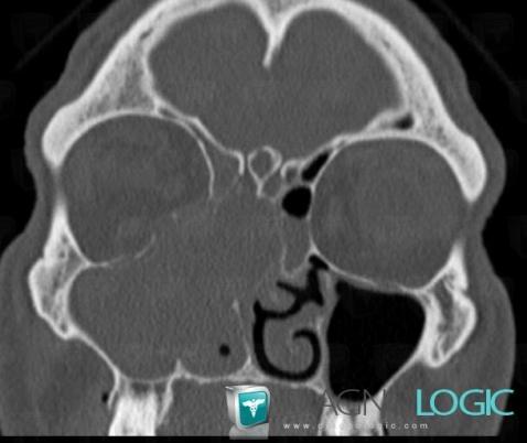 Adénocarcinome, Fosses nasales / Nasopharynx, Sinus, Scanner