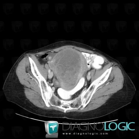 Adénocarcinome-l'endomètre, Utérus, Pelvis / Périnée, Scanner