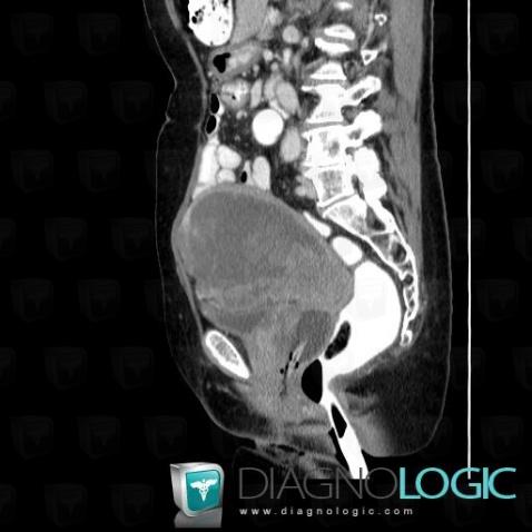 Adénocarcinome-l'endomètre, Utérus, Vagin, Scanner