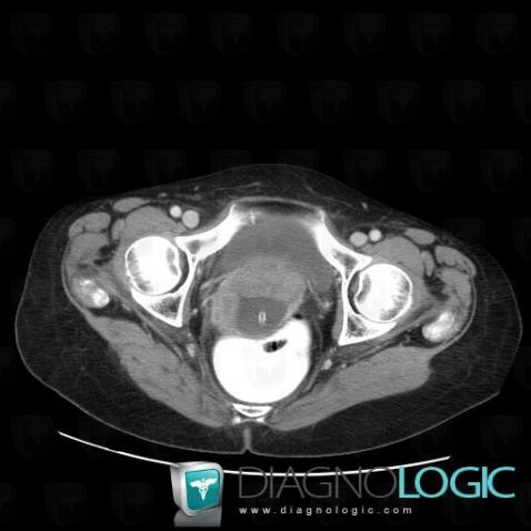 Adénocarcinome-l'endomètre, Vagin, Scanner