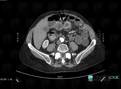 Adénocarcinome-l'intestin grêle, Intestin grêle, Scanner