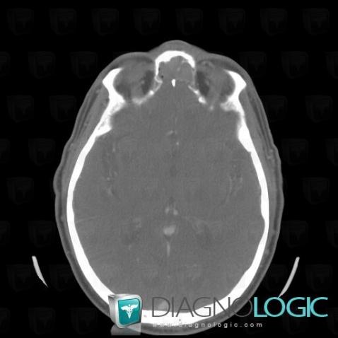 Adénocarcinome, Sinus, Scanner