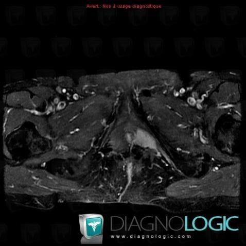 Adenoid cystic carcinoma-bartholin gland, Vagina, MRI