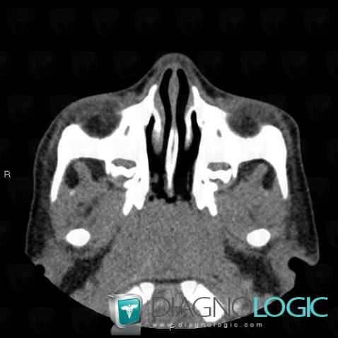 Adenoid hypertrophy, Nasal cavity / Nasopharynx, CT