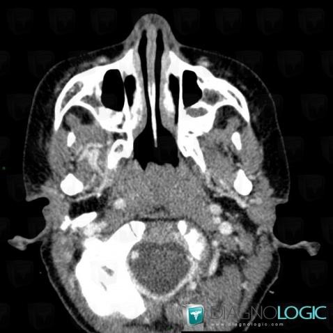 Adenoid hypertrophy, Nasal cavity / Nasopharynx, CT