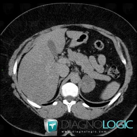 Adenoma, Adrenal glands, CT