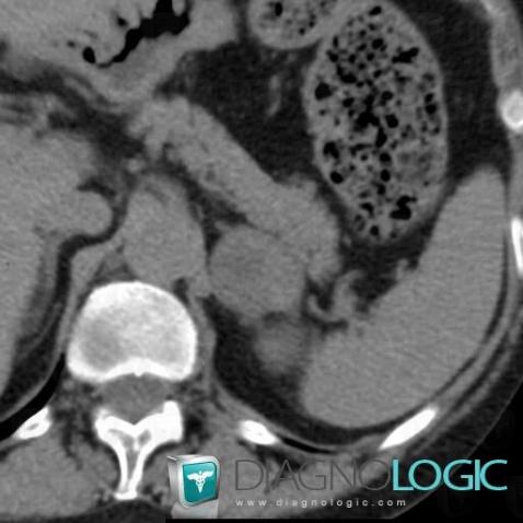 Adenoma, Adrenal glands, CT