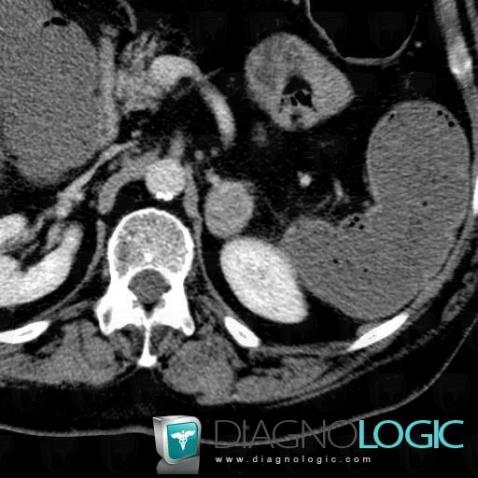 Adenoma, Adrenal glands, CT