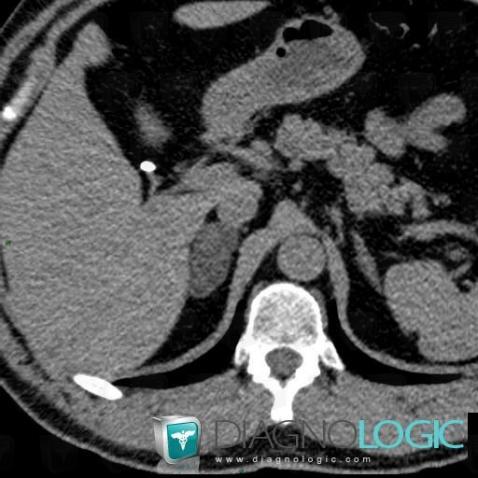 Adenoma, Adrenal glands, CT