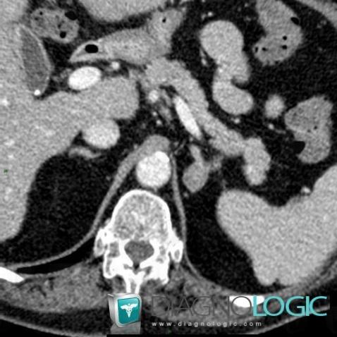 Radiology case : Adenoma (CT ,MRI) - Diagnologic