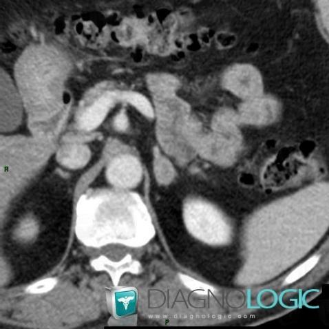 Adenoma, Adrenal glands, CT