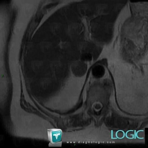 Adenoma, Adrenal glands, MRI