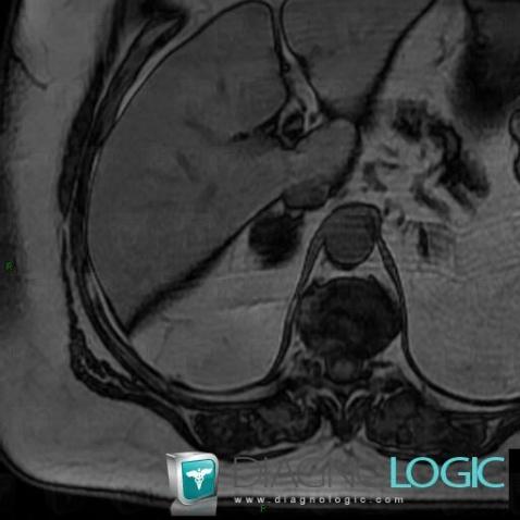 Adenoma, Adrenal glands, MRI