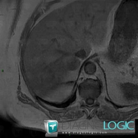 Adenoma, Adrenal glands, MRI